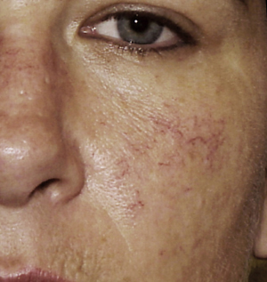 Rosacea - Treatment - NHS Choices